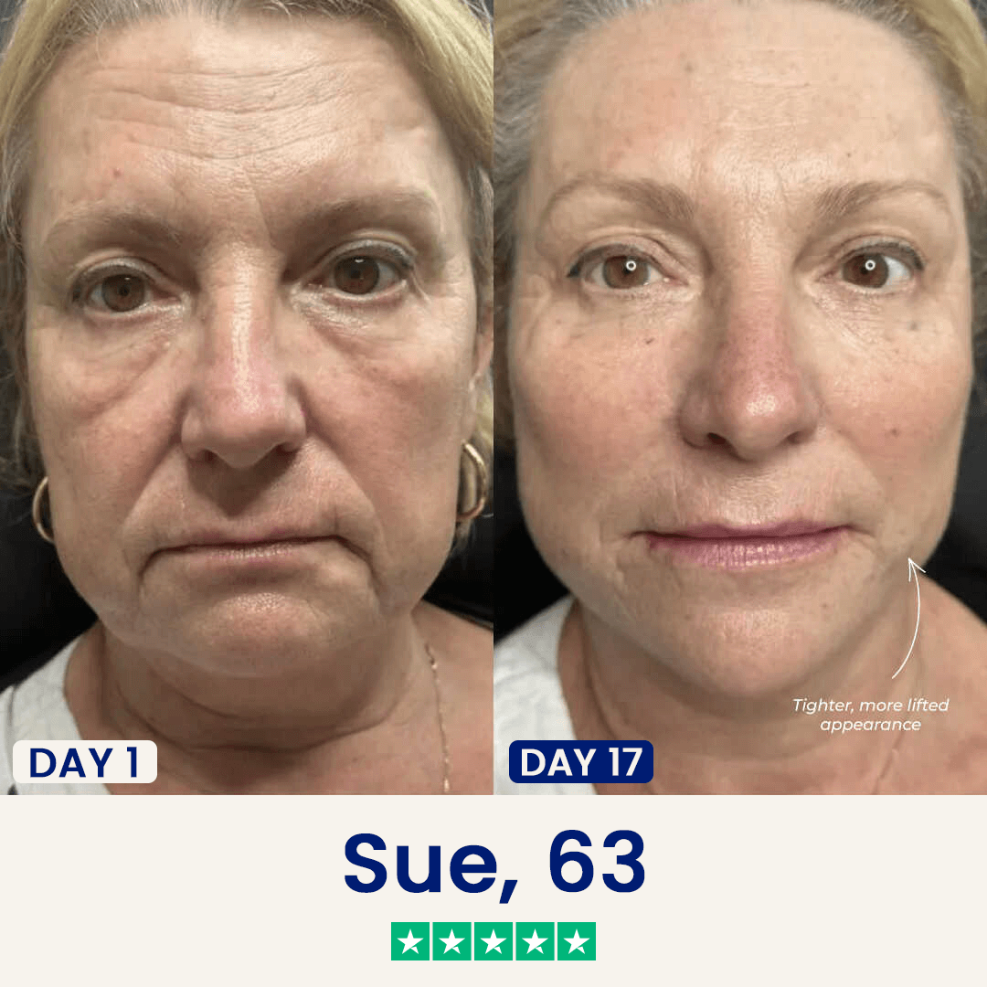 V-Sculpt | Jawline ve Gıdı Toparlayıcı Yüz Bandı